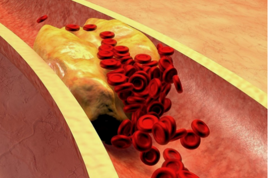 动脉硬化如何改善？胞倍力清血片可有效软化血管远离血栓