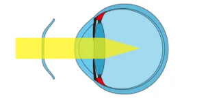 麦迪格角膜塑形镜是如何对角膜“塑形”的？
