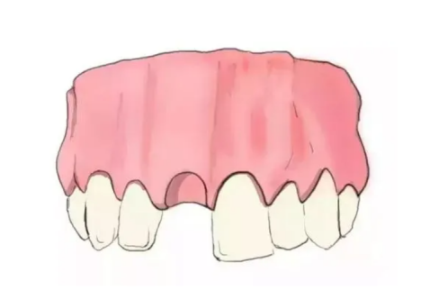 可恩口腔：牙齿缺失影响邻牙！修复牙齿要趁早！
