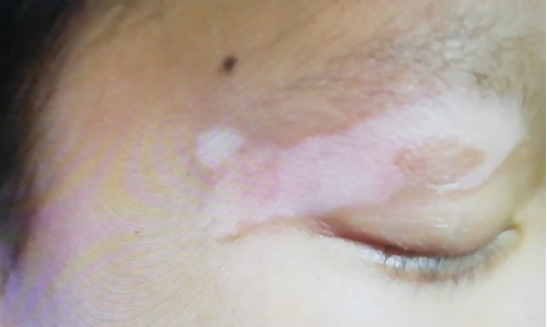 北京白癜风医院哪家好？10岁女童眉毛变白，竟是因为一种病！